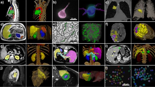 Several pictures of brains scanned organs with colored parts.